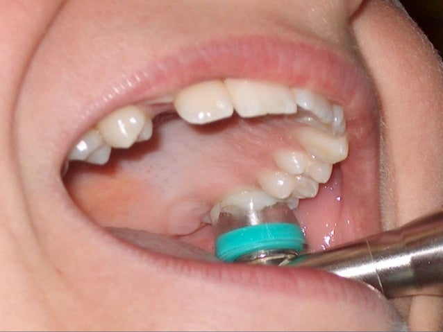 Different techniques for caries removal