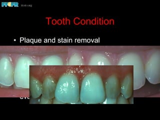 Tooth Condition
•  Plaque and stain removal
•  Moisture retained in teeth
•  Rubber dam isolation
•  Lengthy, challenging color matching
procedures should include applications
of viscous liquid that is resistant to
evaporation
 