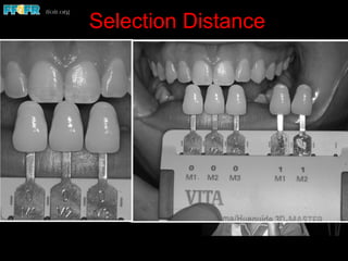 Selection Distance
•  Since natural teeth fall into the lower portion
of the chroma range, decisions regarding the
chromatic aspects of a restoration are more
difficult when the observation takes place
at some distance, and consequently value
becomes more apparent.
 
