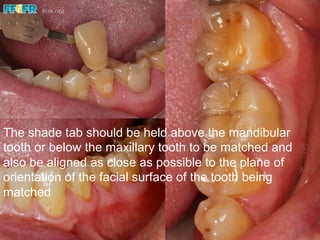 The shade tab should be held above the mandibular
tooth or below the maxillary tooth to be matched and
also be aligned as close as possible to the plane of
orientation of the facial surface of the tooth being
matched
 