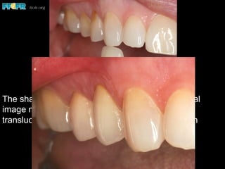 The shade tab should also be inverted and a digital
image made so the technician can compare the
translucency of the shade tab with that of the tooth
 