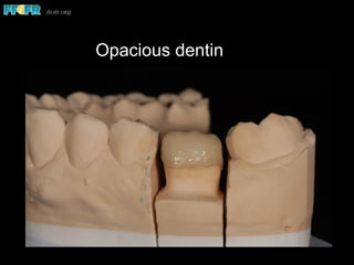 Opacious dentin
 