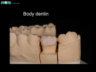Body dentin
 