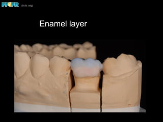 Enamel layer
 