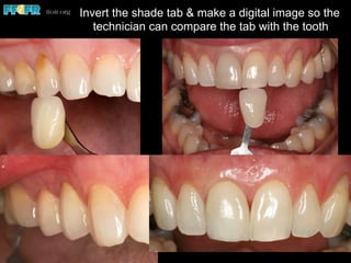 Invert the shade tab & make a digital image so the
technician can compare the tab with the tooth
 