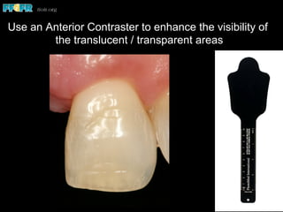 Use an Anterior Contraster to enhance the visibility of
the translucent / transparent areas
 