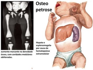 Osteo
petrose
aumento marcante na densidade
óssea, com cavidades medulares
obliteradas.
Hepato e
esplenomegalia
por causa de
hematopoiese
extramedular
 