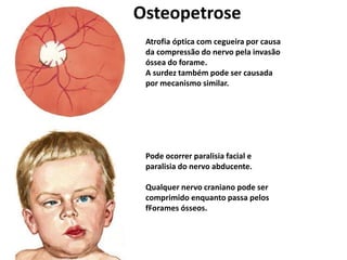 Atrofia óptica com cegueira por causa
da compressão do nervo pela invasão
óssea do forame.
A surdez também pode ser causada
por mecanismo similar.
Pode ocorrer paralisia facial e
paralisia do nervo abducente.
Qualquer nervo craniano pode ser
comprimido enquanto passa pelos
fForames ósseos.
Osteopetrose
 