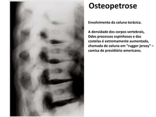 Envolvimento da coluna torácica.
A densidade dos corpos vertebrais,
Ddos processos espinhosos e das
costelas é extremamente aumentada,
chamada de coluna em “rugger jersey” –
camisa de presidiário americano.
Osteopetrose
 