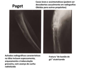Casos leves e assintomáticos (podem ser
descobertos casualmente em radiografias
Obtidas para outros propósitos)Paget
Achados radiográficos característicos
na tíbia incluem espessamento,
arqueamento e trabeculação
grosseira, com avanço de cunha
radiolúcida
Fratura “de bastão de
giz” cicatrizando
 