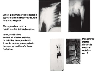 Úmero proximal parece espessado
E grosseiramente trabeculado, com
rarefação irregular.
Fêmur proximal mostra
manifestações típicas da doença.
Radiografias acima
obtidas do mesmo paciente.
Os achados correspondem às
áreas de captura aumentada de
isótopos na cintilografia óssea
(à direita).
Mielograma
mostra
obstrução
do canal
vertebral
em L3
 