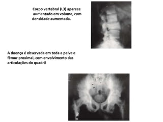 Corpo vertebral (L3) aparece
aumentado em volume, com
densidade aumentada.
A doença é observada em toda a pelve e
fêmur proximal, com envolvimento das
articulações do quadril
 