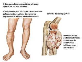 A doença pode ser monostótica, afetando
apenas um osso ou vértebra.
O envolvimento da tíbia direita é evidenciado
pelo aumento de volume do membro e
arqueamento. A fíbula não está envolvida.
Sarcoma do rádio pagético
A doença antiga
pode ser submetida
à degeneração
sarcomatosa
(<1% dos casos
sintomáticos
 
