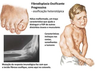 Fibrodisplasia Ossificante
Progressiva
- ossificação heterotópica
Hálux malformado, um traço
característico que ajuda a
distinguir a FOP de outros
distúrbios ósseos e musculares
Característicos
inchaços nas
costas,
semelhantes
a tumores
Mutação da resposta imunológica faz com que
o tecido fibroso ossifique, como aqui no cotovelo.
 