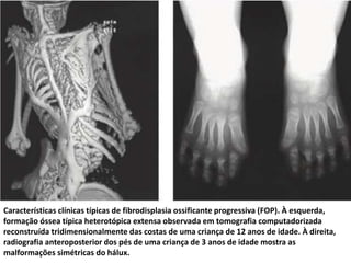 Características clínicas típicas de fibrodisplasia ossificante progressiva (FOP). À esquerda,
formação óssea típica heterotópica extensa observada em tomografia computadorizada
reconstruída tridimensionalmente das costas de uma criança de 12 anos de idade. À direita,
radiografia anteroposterior dos pés de uma criança de 3 anos de idade mostra as
malformações simétricas do hálux.
 