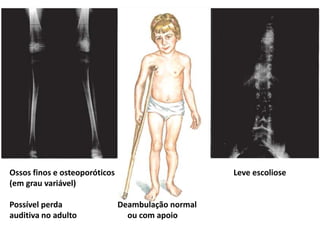 Ossos finos e osteoporóticos Leve escoliose
(em grau variável)
Possível perda Deambulação normal
auditiva no adulto ou com apoio
 
