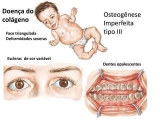 Osteogênese
Imperfeita
tipo III
Doença do
colágeno
Escleras de cor variável
Dentes opalescentes
Face triangulada
Deformidades severas
 