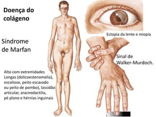 Síndrome
de Marfan
Doença do
colágeno
Alto com extremidades
Longas (dolicoestenomelia),
escoliose, peito escavado
ou peito de pombo), lassidão
articular, aracnodactilia,
pé plano e hérnias inguinais
Ectopia da lente e miopia
Sinal de
Walker-Murdoch.
 