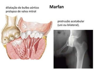 dilatação do bulbo aórtico
prolapso de valva mitral
protrusão acetabular
(uni ou bilateral).
Marfan
 