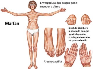 Envergadura dos braços pode
exceder a altura
Aracnodactilia
Sinal de Steinberg
a ponta do polegar
protrui quando
o polegar é cruzado
na palma da mão
Marfan
 