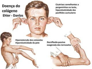 Cicatrizes semelhantes a
pergaminhos na testa,
hiperelasticidade dos
pavilhões auriculares
Hiperextensão dos cotovelos
Hiperelasticidade da pele Dorsiflexão passiva
exagerada dos tornozelos
Ehler - Danlos
Doença do
colágeno
 