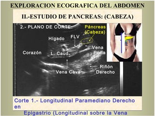 EXPLORACION ECOGRAFICA DEL ABDOMEN
Vena Cava
L. Caud.
Vena
Porta
FLV
Páncreas
(Cabeza)
Hígado
Corazón
Riñón
Derecho
Corte 1.- Longitudinal Paramediano Derecho
en
Epigastrio (Longitudinal sobre la Vena
II.-ESTUDIO DE PANCREAS: (CABEZA)
2.- PLANO DE CORTE:
 