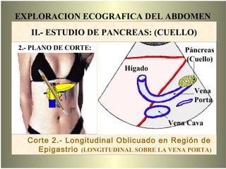 EXPLORACION ECOGRAFICA DEL ABDOMEN
Corte 2
Corte 2.- Longitudinal Oblicuado en Región de
Epigastrio (LONGITUDINAL SOBRE LA VENA PORTA)
Páncreas
(Cuello)
Vena
Porta
Vena Cava
Hígado
2.- PLANO DE CORTE:
II.- ESTUDIO DE PANCREAS: (CUELLO)
 