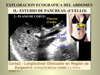 EXPLORACION ECOGRAFICA DEL ABDOMEN
Páncreas
(Cuello)
Corte2.- Longitudinal Oblicuado en Región de
Epigastrio (LONGITUDINAL SOBRE LA VENA
PORTA)
2.- PLANO DE CORTE:
II.- ESTUDIO DE PANCREAS: (CUELLO)
Vena
Porta
Vena Cava
 