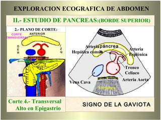 EXPLORACION ECOGRAFICA DE ABDOMEN
Arteria
Hepática común
Arteria
Esplénica
Vena Cava
Arteria Aorta
Vértebra
páncrea
s
Tronco
Celiaco
SIGNO DE LA GAVIOTA
Corte 4
Corte 4.- Transversal
Alto en Epigastrio
D
E
R
POSTERIOR
ANTERIOR
I
Z
Q
CORTE
TRANSVERSAL
2.- PLANO DE CORTE:
II.- ESTUDIO DE PANCREAS:(BORDE SUPERIOR)
 