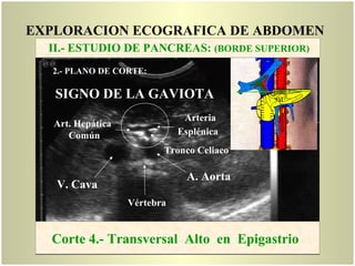 EXPLORACION ECOGRAFICA DE ABDOMEN
A. Aorta
Arteria
Esplénica
Art. Hepática
Común
Tronco Celiaco
V. Cava
Vértebra
SIGNO DE LA GAVIOTA
Corte 4.- Transversal Alto en Epigastrio
II.- ESTUDIO DE PANCREAS: (BORDE SUPERIOR)
2.- PLANO DE CORTE:
 