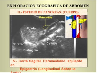 EXPLORACION ECOGRAFICA DE ABDOMEN
Aorta
Tronco
Celiaco
AMS
Páncreas
Hígado
Corazón
Diafragma
5.- Corte Sagital Paramediano Izquierdo
en
Epigastrio (Longitudinal Sobre la
Corte 5
II.- ESTUDIO DE PANCREAS: (CUERPO)
 
