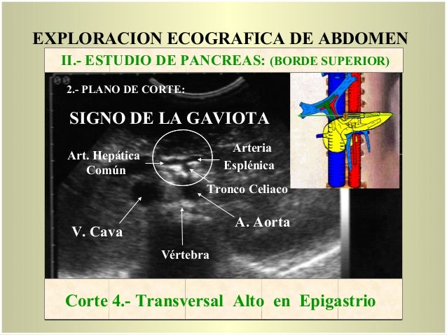 Signo De La Gaviota Ecografia