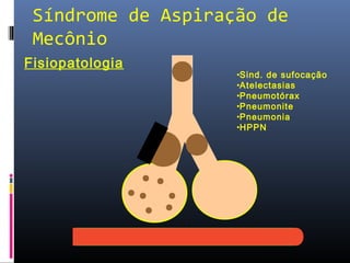 Síndrome de Aspiração de
Mecônio
Fisiopatologia
•Sind. de sufocação
•Atelectasias
•Pneumotórax
•Pneumonite
•Pneumonia
•HPPN
 