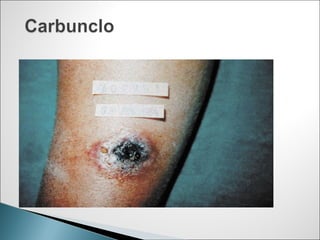 3.infecciones en cirugía | PPT