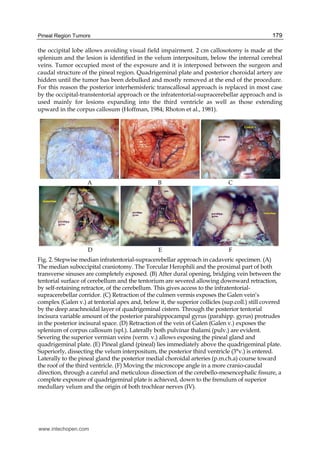 Pineal Region Tumors 179
the occipital lobe allows avoiding visual field impairment. 2 cm callosotomy is made at the
splenium and the lesion is identified in the velum interpositum, below the internal cerebral
veins. Tumor occupied most of the exposure and it is interposed between the surgeon and
caudal structure of the pineal region. Quadrigeminal plate and posterior choroidal artery are
hidden until the tumor has been debulked and mostly removed at the end of the procedure.
For this reason the posterior interhemisferic transcallosal approach is replaced in most case
by the occipital-transtentorial approach or the infratentorial-supracerebellar approach and is
used mainly for lesions expanding into the third ventricle as well as those extending
upward in the corpus callosum (Hoffman, 1984; Rhoton et al., 1981).
A B C
D E F
Fig. 2. Stepwise median infratentorial-supracerebellar approach in cadaveric specimen. (A)
The median suboccipital craniotomy. The Torcular Herophili and the proximal part of both
transverse sinuses are completely exposed. (B) After dural opening, bridging vein between the
tentorial surface of cerebellum and the tentorium are severed allowing downward retraction,
by self-retaining retractor, of the cerebellum. This gives access to the infratentorial-
supracerebellar corridor. (C) Retraction of the culmen vermis exposes the Galen vein’s
complex (Galen v.) at tentorial apex and, below it, the superior collicles (sup.coll.) still covered
by the deep arachnoidal layer of quadrigeminal cistern. Through the posterior tentorial
incisura variable amount of the posterior parahippocampal gyrus (parahipp. gyrus) protrudes
in the posterior incisural space. (D) Retraction of the vein of Galen (Galen v.) exposes the
splenium of corpus callosum (spl.). Laterally both pulvinar thalami (pulv.) are evident.
Severing the superior vermian veins (verm. v.) allows exposing the pineal gland and
quadrigeminal plate. (E) Pineal gland (pineal) lies immediately above the quadrigeminal plate.
Superiorly, dissecting the velum interpositum, the posterior third ventricle (3°v.) is entered.
Laterally to the pineal gland the posterior medial choroidal arteries (p.m.ch.a) course toward
the roof of the third ventricle. (F) Moving the microscope angle in a more cranio-caudal
direction, through a careful and meticulous dissection of the cerebello-mesencephalic fissure, a
complete exposure of quadrigeminal plate is achieved, down to the frenulum of superior
medullary velum and the origin of both trochlear nerves (IV).
www.intechopen.com
 