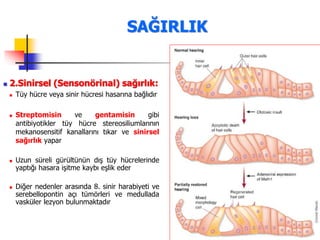 51
 2.Sinirsel (Sensonörinal) sağırlık:
 Tüy hücre veya sinir hücresi hasarına bağlıdır
 Streptomisin ve gentamisin gibi
antibiyotikler tüy hücre stereosiliumlarının
mekanosensitif kanallarını tıkar ve sinirsel
sağırlık yapar
 Uzun süreli gürültünün dış tüy hücrelerinde
yaptığı hasara işitme kaybı eşlik eder
 Diğer nedenler arasında 8. sinir harabiyeti ve
serebellopontin açı tümörleri ve medullada
vasküler lezyon bulunmaktadır
SAĞIRLIK
 