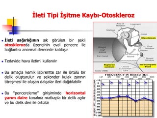 55
İleti Tipi İşitme Kaybı-Otoskleroz
 İleti sağırlığının sık görülen bir şekli
otosklerozda üzenginin oval pencere ile
bağlantısı anormal derecede katılaşır
 Tedavide hava iletimi kullanılır
 Bu amaçla kemik labirentte zar ile örtülü bir
delik oluşturulur ve sekonder kulak zarının
titreşmesi ile oluşan dalgalar ileri dağıtılabilir
 Bu “pencereleme” girişiminde horizontal
yarım daire kanalına matkapla bir delik açılır
ve bu delik deri ile örtülür
 