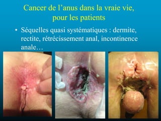 HPV et anus