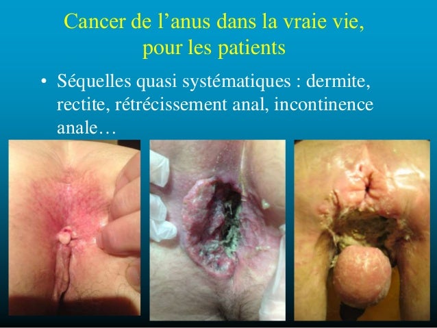 Hpv anal cancer