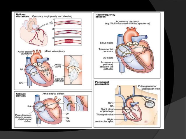 3.therapeutic procedure of cvs | PPT