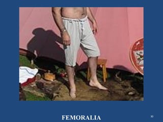 30
FEMORALIA
 