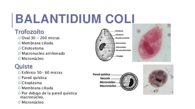 Balantidiasis