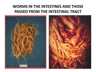 WORMS IN THE INTESTINES AND THOSE
PASSED FROM THE INTESTINAL TRACT
 