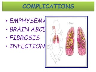 COMPLICATIONS
• EMPHYSEMA
• BRAIN ABCESS
• FIBROSIS
• INFECTIONS
 