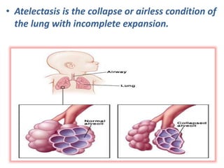 • Atelectasis is the collapse or airless condition of
the lung with incomplete expansion.
 