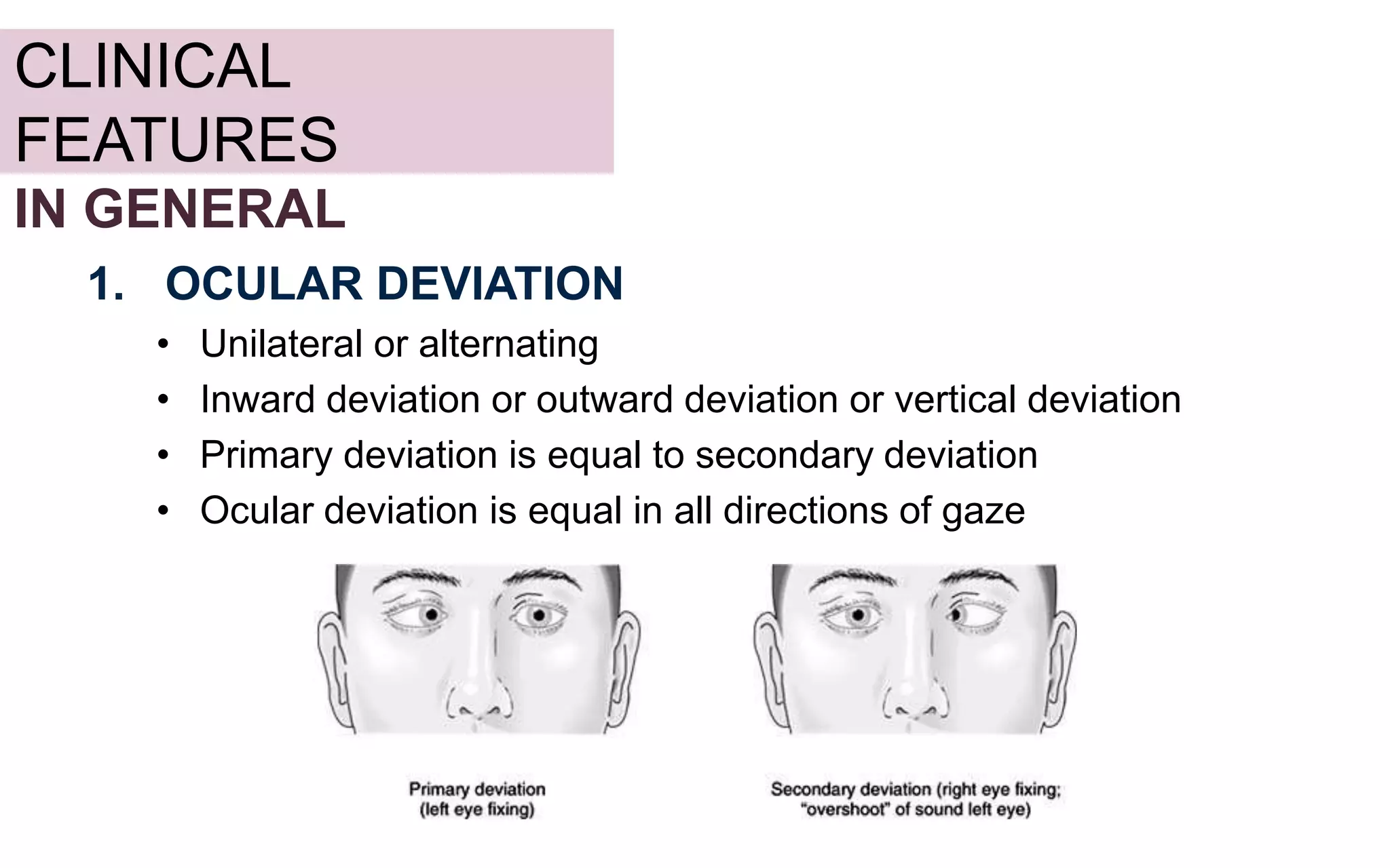 concomitant strabismus | PPTX