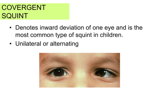 concomitant strabismus | PPTX | Eye and Vision Conditions | Diseases ...