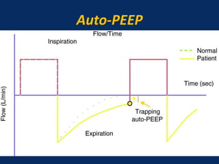 Auto-PEEP
June 1, 2016 31
 