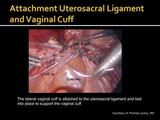 Courtesy of Thomas Lyons, MD.
The lateral vaginal cuff is attached to the uterosacral ligament and tied
into place to support the vaginal cuff
 