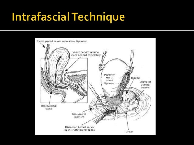 evidence base steps hysterectomy